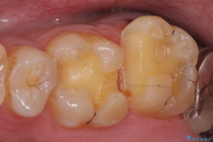 【20代男性】銀歯を白くしたい 治療途中画像