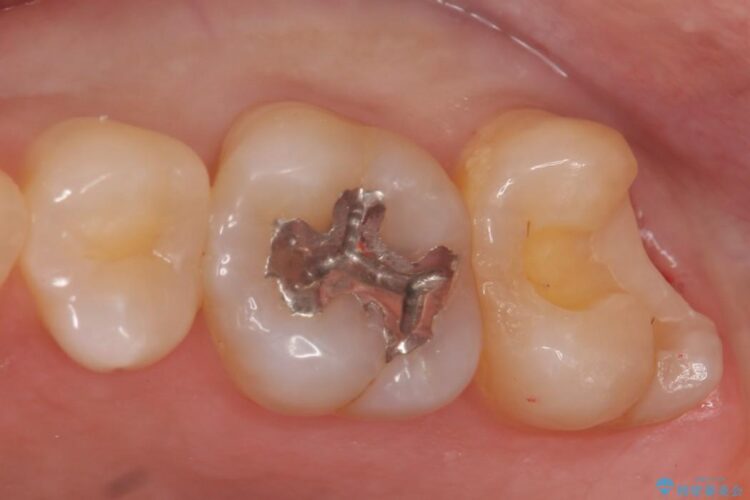 【20代男性】深い虫歯を長持ちするゴールドインレーで治療 治療途中画像