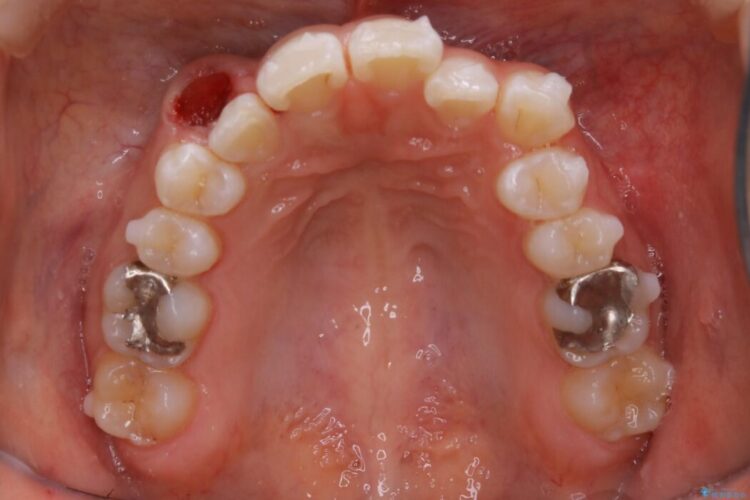 【20代女性】生まれつき歯の本数が足りない先天欠如を治療する 治療途中画像
