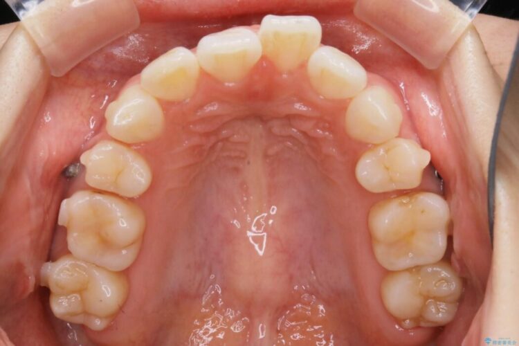 【20代女性】10代の頃にした矯正の後戻りを再矯正する 治療途中画像