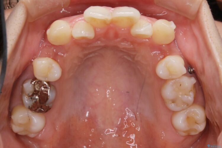 【20代女性】抜歯矯正で叢生をなおす 治療途中画像