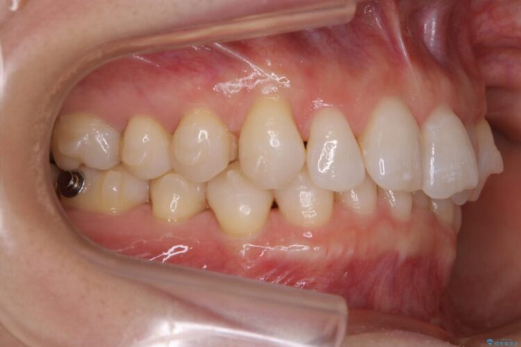 【30代女性】歯根破折と歯列矯正の治療で噛み合わせを改善 治療途中画像