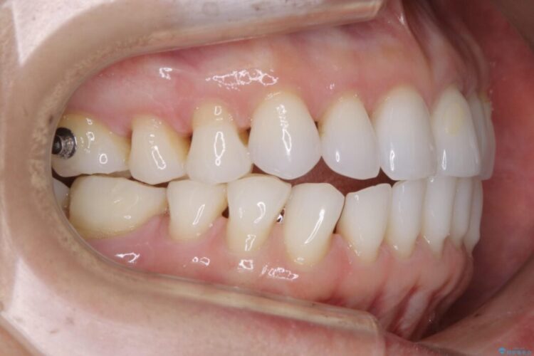 【40代女性】開咬(オープンバイト)の非抜歯インビザライン矯正治療 治療途中画像