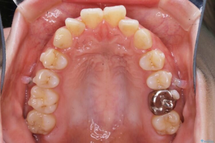 【20代女性】非抜歯で口ゴボ改善するインビザライン矯正治療 治療途中画像