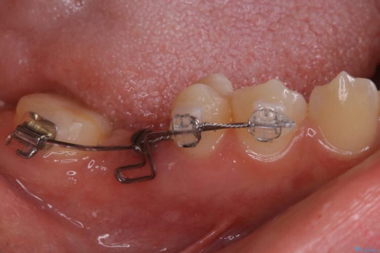 【20代女性】傾斜してしまった奥歯の部分矯正を併用したブリッジ治療 治療途中画像