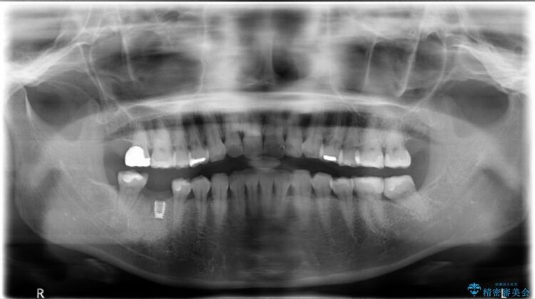 【30代女性】右下奥歯のインプラント 治療例 治療途中画像