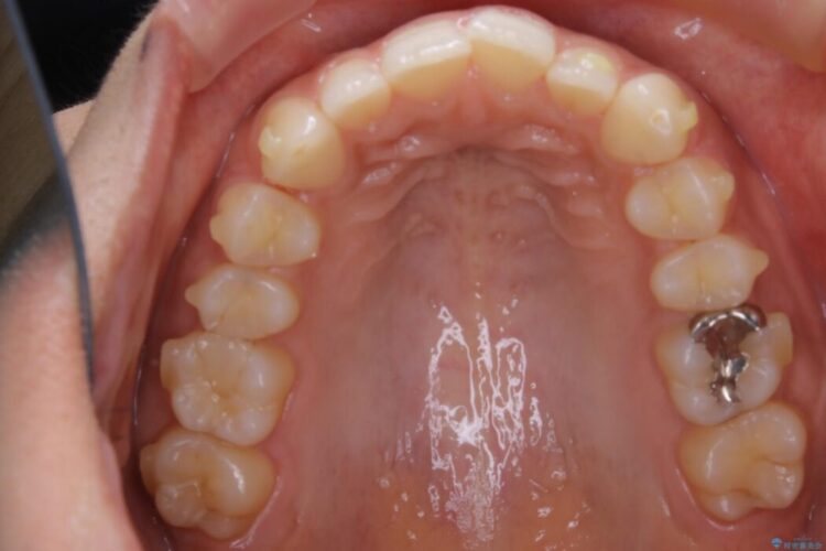 【30代女性】ガタつきのある狭窄歯列を改善する 治療途中画像