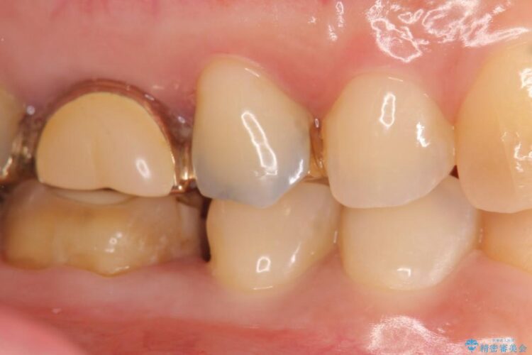 【40代女性】古い不適合な詰め物をセラミックインレーで再治療 治療途中画像