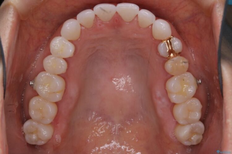 【40代女性】開咬(オープンバイト)の非抜歯インビザライン矯正治療 治療途中画像