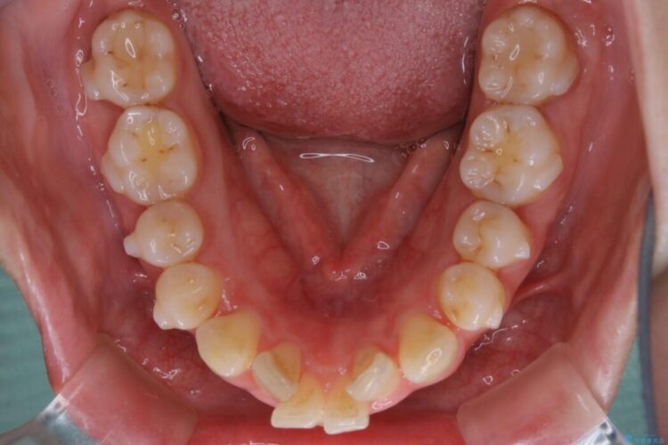【20代女性】非抜歯で口ゴボ改善するインビザライン矯正治療 治療途中画像