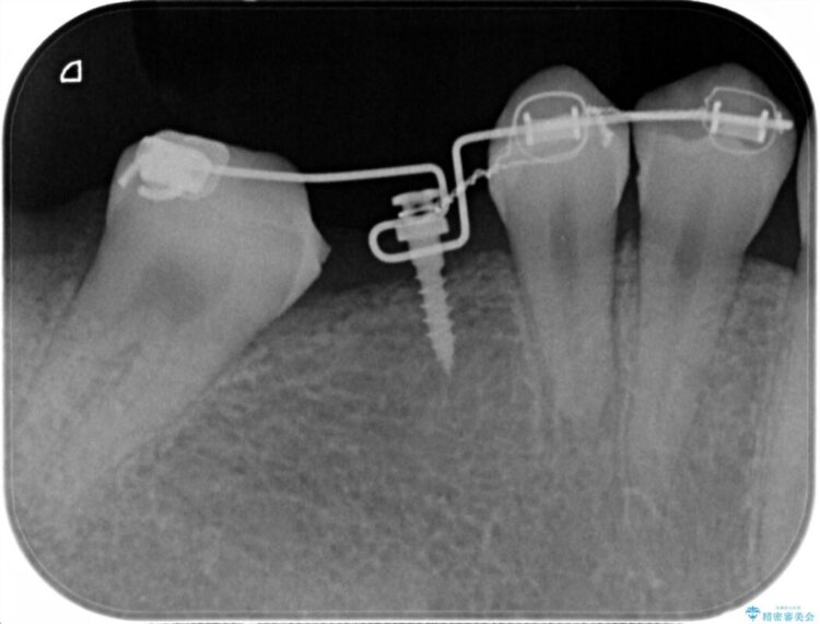 【20代女性】傾斜してしまった奥歯の部分矯正を併用したブリッジ治療 治療途中画像