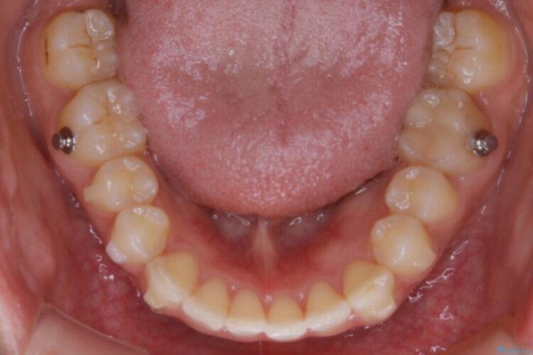 【30代女性】ガタつきのある狭窄歯列を改善する 治療途中画像