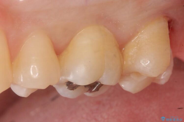 【20代男性】深い虫歯を長持ちするゴールドインレーで治療 治療途中画像