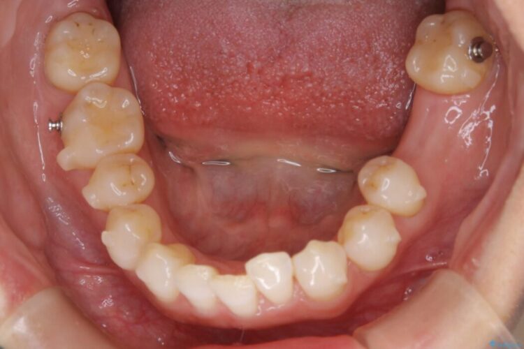 【30代女性】歯根破折と歯列矯正の治療で噛み合わせを改善 治療途中画像