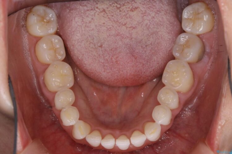 【40代女性】開咬(オープンバイト)の非抜歯インビザライン矯正治療 治療途中画像