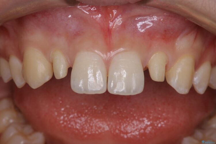 【10代女性】生まれつき小さい歯をセラミックで補綴しすきっ歯を改善する 治療途中画像