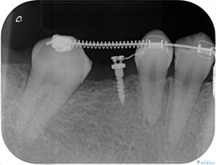 【20代女性】傾斜してしまった奥歯の部分矯正を併用したブリッジ治療 治療途中画像
