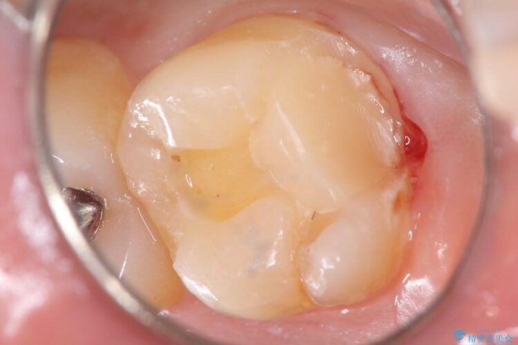 【20代男性】深い虫歯を長持ちするゴールドインレーで治療 治療途中画像