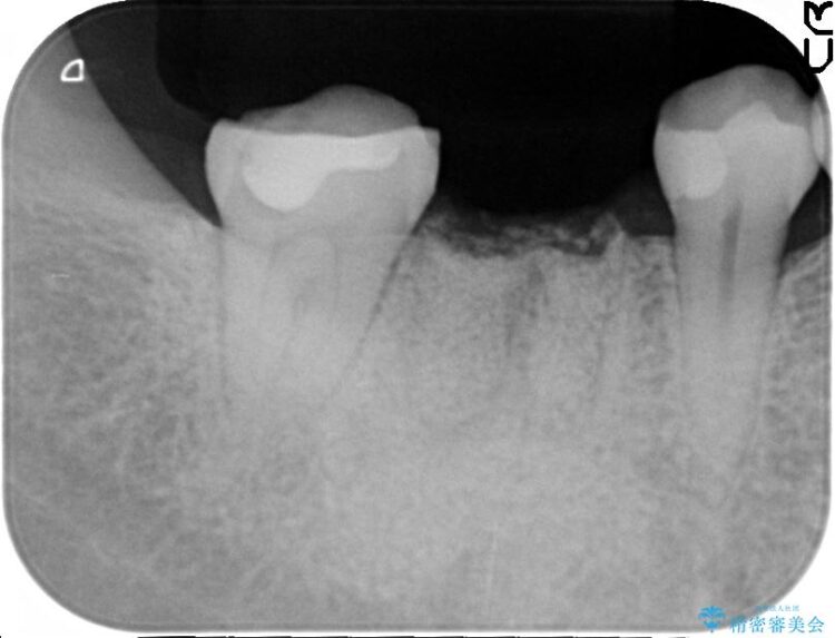 【30代女性】右下奥歯のインプラント 治療例 治療途中画像