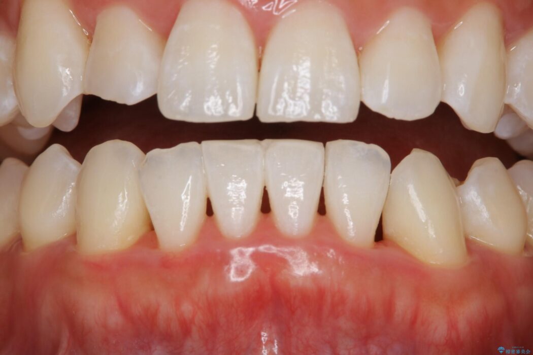 【30代男性】歯肉のブラックトライアングル治療 治療前