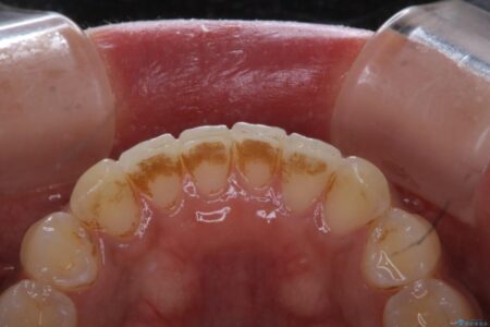 【20代女性】タバコのヤニ（ニコチン、タール）を徹底的に除去 治療前