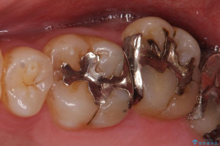 【20代男性】銀歯を白くしたい 治療前画像