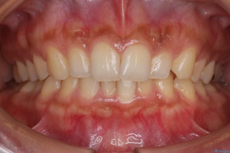 【30代女性】ガタつきのある狭窄歯列を改善する 治療前画像