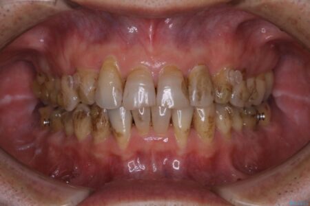 【40代男性】インビザライン治療中の頑固な着色落としをクリーニング 治療前
