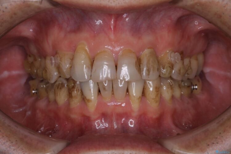 【40代男性】インビザライン治療中の頑固な着色落としをクリーニング 治療前画像