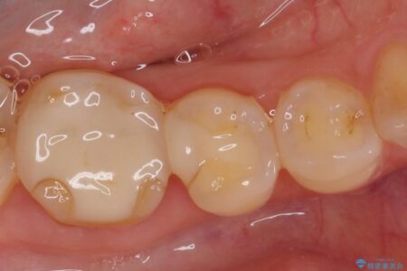 【40代女性】古い不適合な詰め物をセラミックインレーで再治療 治療前