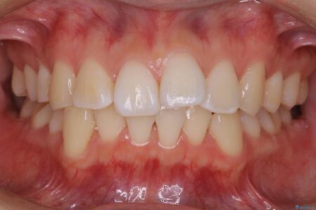 【20代女性】10代の頃にした矯正の後戻りを再矯正する 治療前