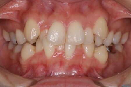 【20代女性】抜歯矯正で叢生をなおす 治療前