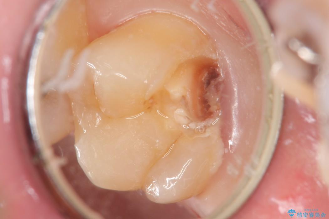 【20代男性】深い虫歯を長持ちするゴールドインレーで治療 治療前