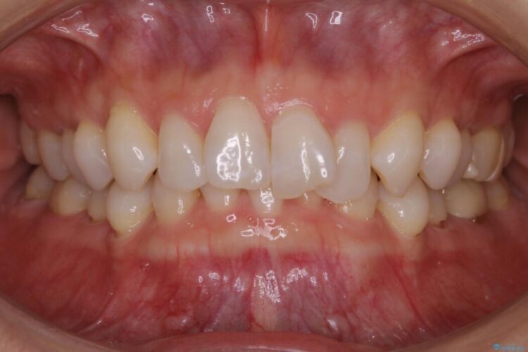 【30代女性】歯根破折と歯列矯正の治療で噛み合わせを改善 治療前画像