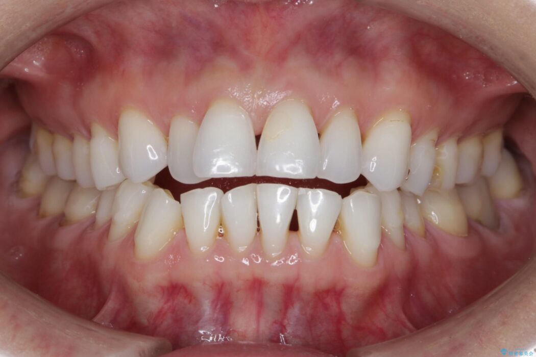 【40代女性】開咬(オープンバイト)の非抜歯インビザライン矯正治療 治療前