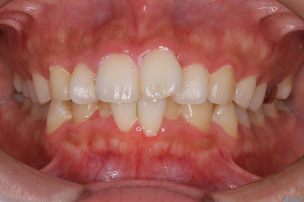 【20代女性】非抜歯で口ゴボ改善するインビザライン矯正治療 治療前