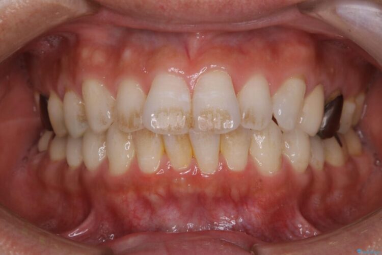 【30代男性】1年ぶりのクリーニング(コーヒーによる着色落とし) ビフォー