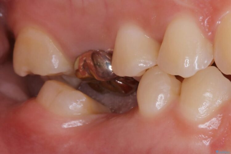 【20代女性】傾斜してしまった奥歯の部分矯正を併用したブリッジ治療 治療前画像