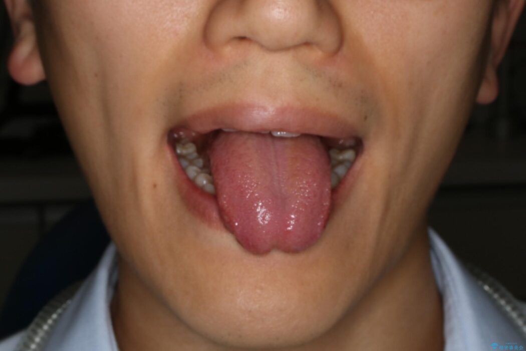 【20代男性】滑舌の悪さを改善したい！舌小帯切除術 治療前