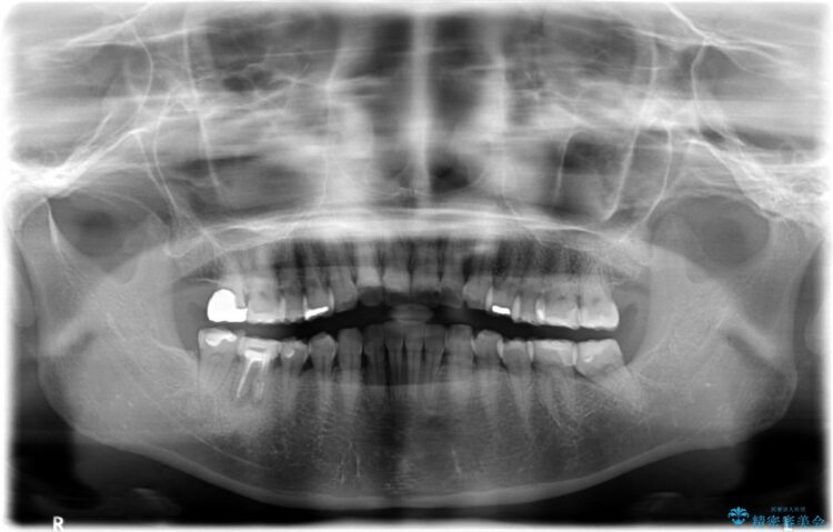 【30代女性】右下奥歯のインプラント 治療例 治療前画像