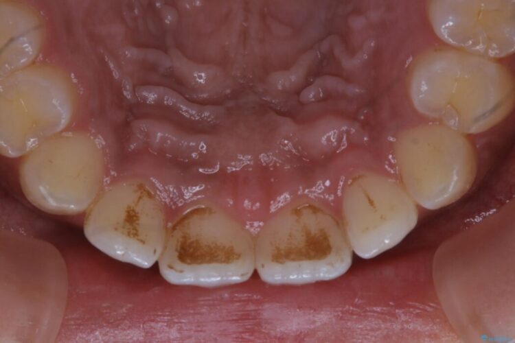 【20代女性】タバコのヤニ（ニコチン、タール）を徹底的に除去 治療前画像