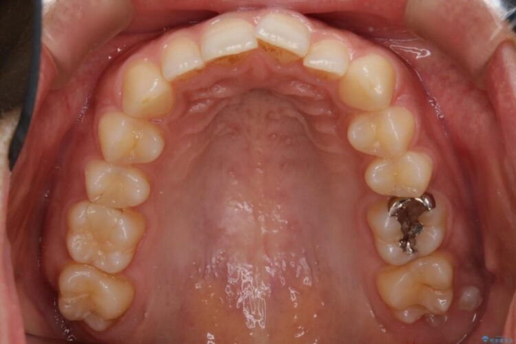 【30代女性】ガタつきのある狭窄歯列を改善する 治療前画像