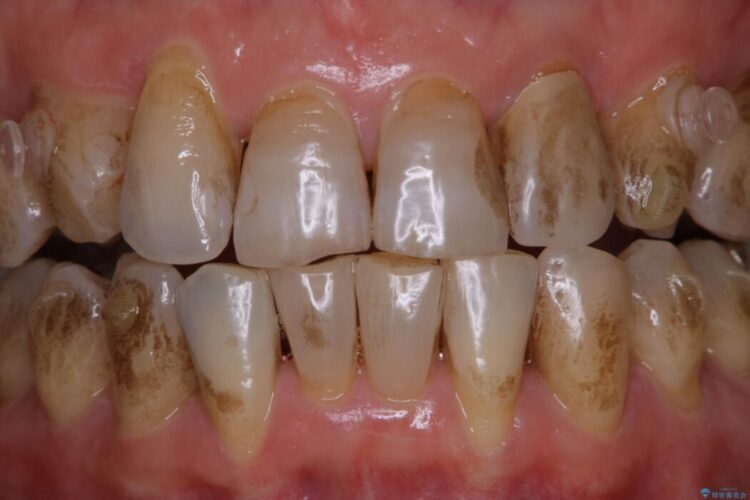 【40代男性】インビザライン治療中の頑固な着色落としをクリーニング 治療前画像