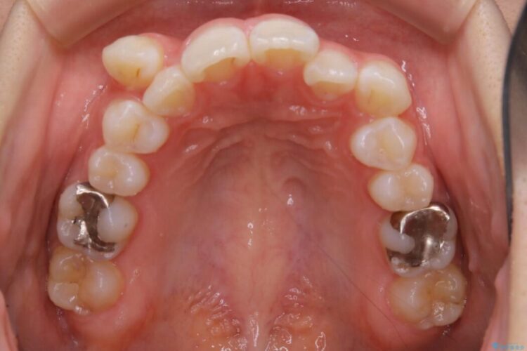 【20代女性】生まれつき歯の本数が足りない先天欠如を治療する 治療前画像