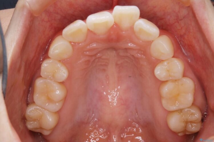 【20代女性】10代の頃にした矯正の後戻りを再矯正する 治療前画像