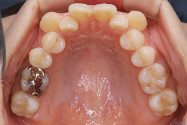 【20代女性】抜歯矯正で叢生をなおす 治療前画像