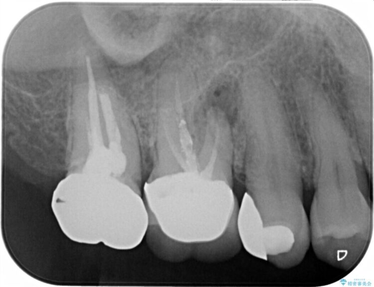 【40代女性】繰り返しニキビのようなものができる 治療前画像