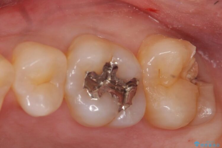 【20代男性】深い虫歯を長持ちするゴールドインレーで治療 治療前画像