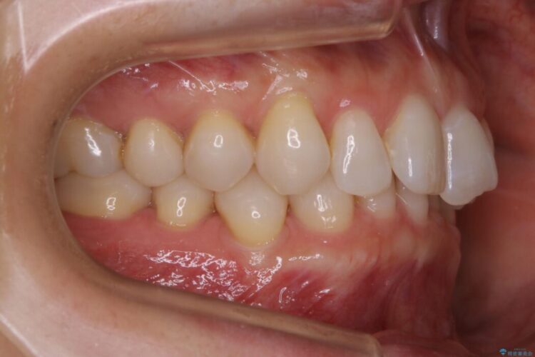 【30代女性】歯根破折と歯列矯正の治療で噛み合わせを改善 治療前画像