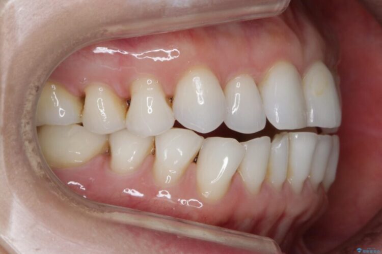 【40代女性】開咬(オープンバイト)の非抜歯インビザライン矯正治療 治療前画像